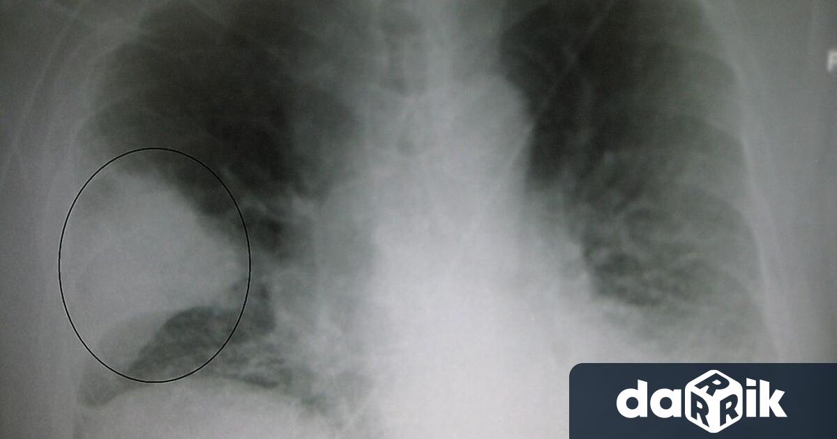 12 ноември е международен ден за борба с пневмонията. Отбелязва