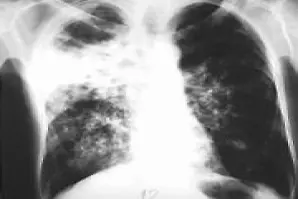 От днес в „УМБАЛ-Д-р Георги Странски“ - Плевен: Безплатна кампания за превенция от туберкулоза 