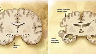 Световен ден за борба с болеста на Алцхаймер - 21 септември