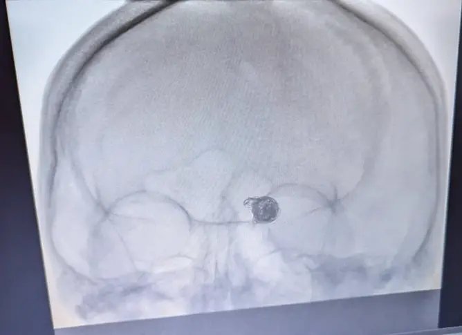  Първата ендовазална емболизация на мозъчно-съдова аневризма сполучливо осъществена в УМБАЛ „ Д-р Георги Странски “ 