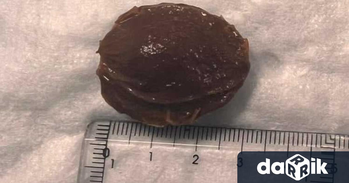 ЛекаривПловдив извадиха костилка от кайсия заседнала в хранопровода на 53 годишен