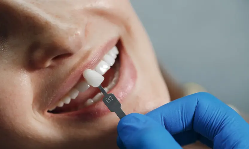  Усмивката, която трансформира всичко – по какъв начин фасетите връщат увереността 