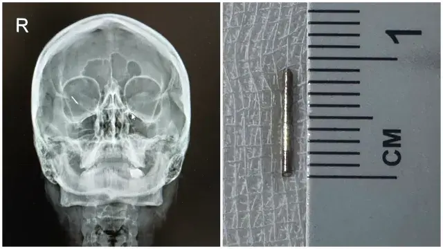 Жена от Русе имаше 10-милиметрова шнола в окото, спасиха зрението й