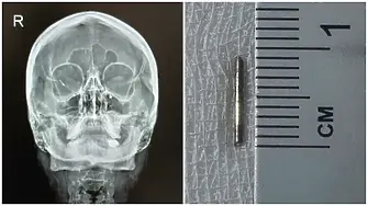 Жена от Русе имаше 10-милиметрова шнола в окото, спасиха зрението й