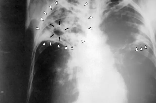 На 12-ти ноември се отбелязва Световният ден за борба с пневмонията