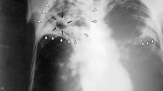 На 12-ти ноември се отбелязва Световният ден за борба с пневмонията