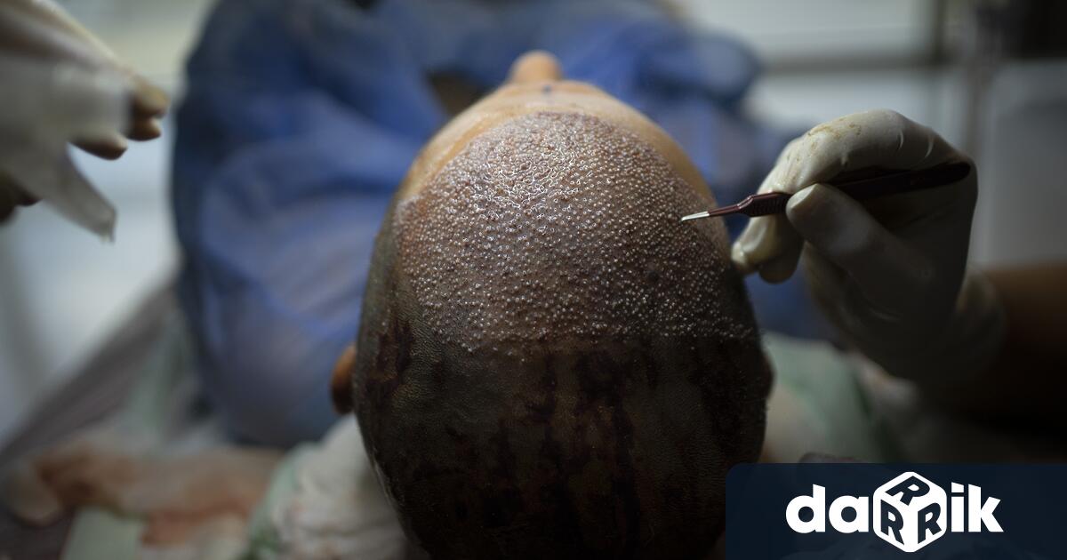 36 годишен британец почина след присаждане на коса и стоматологични процедури