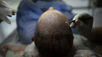 Мъж издъхна след трансплантация на коса в Турция