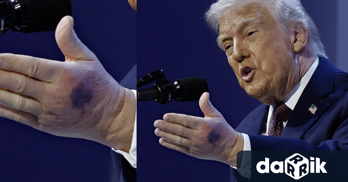 Доналд Тръмп заяви че голямата лилава синина на лявата му