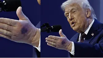 Тръмп с огромна синина и на лявата ръка