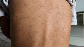 17 болни деца от морбили във Враца