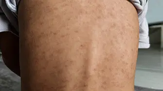 17 болни деца от морбили във Враца