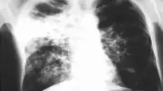 24-ти март е Световен ден за борба с туберколозата