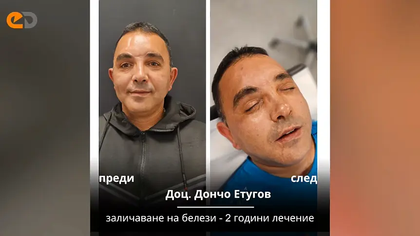 „Мамо, виж колко е грозен!“: Лице назаем и светлата страна на естетичната медицина след тежка травма
