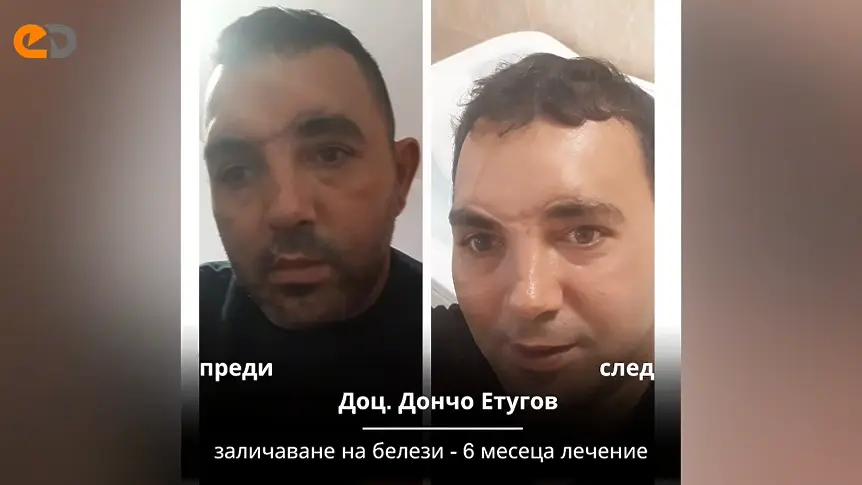 „Мамо, виж колко е грозен!“: Лице назаем и светлата страна на естетичната медицина след тежка травма